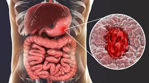 Ulcère gastro-duodénal, SYMPTOMES, CAUSES, TRAITEMENTS