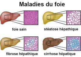 Les maladies du foie, causes, symptômes, remèdes