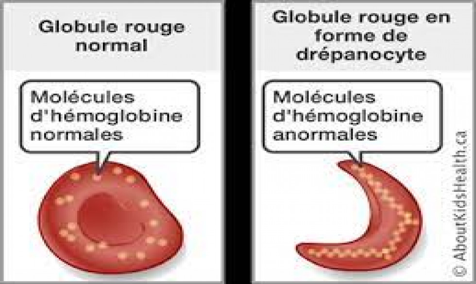 Drépanocytose - symptômes, causes, traitements et prévention