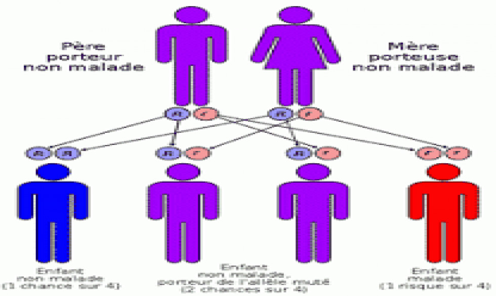 Drépanocytose - symptômes, causes, traitements et prévention