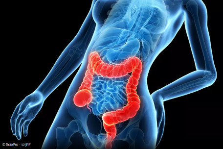 Cancer colorectal chez la femme : 5 symptômes qui doivent inquiéter