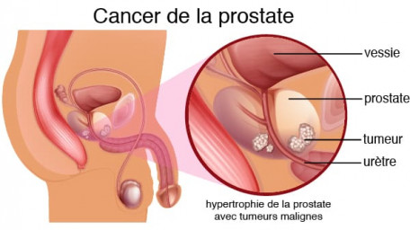 Cancer de la prostate